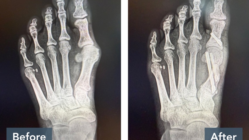 Before and after x-rays of a foot showing surgical correction of a bunion with improved alignment of the big toe.