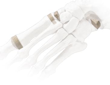 Diagram of bones in a human foot highlighting joints and cartilage sections.