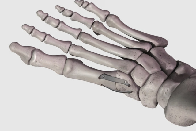 3D illustration of a human foot skeleton with medical hardware on a white background.