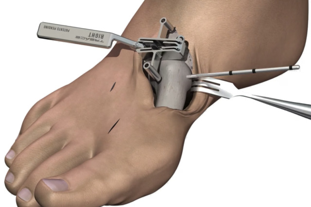Medical illustration showing an ankle implant procedure with surgical tools in use.