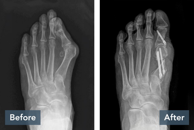 X-ray image showing foot before surgery on left and after surgery with pins on right.