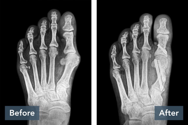 X-ray comparison of a foot before and after treatment, showing bone alignment improvements.