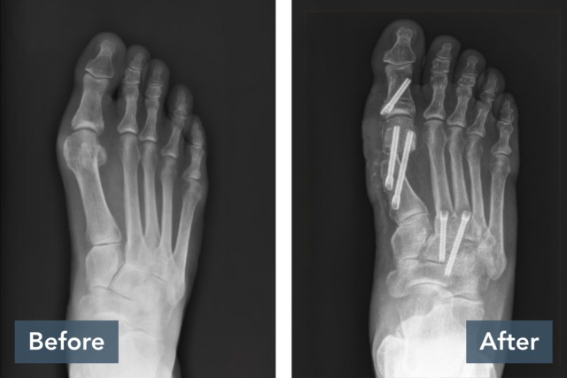 Before and after images of a foot X-ray showing surgical screws post-bunion surgery.