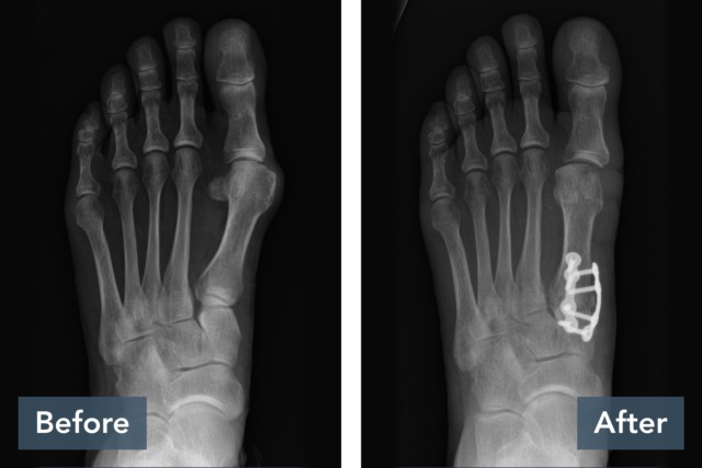 X-ray of a foot with screws and plates in bones after bunion surgery, before and after comparison.
