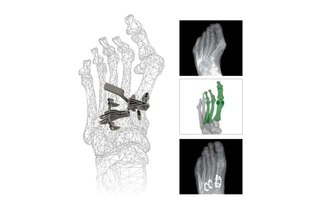 3D wireframe foot model with X-ray showing internal metal plates and green bones on side.