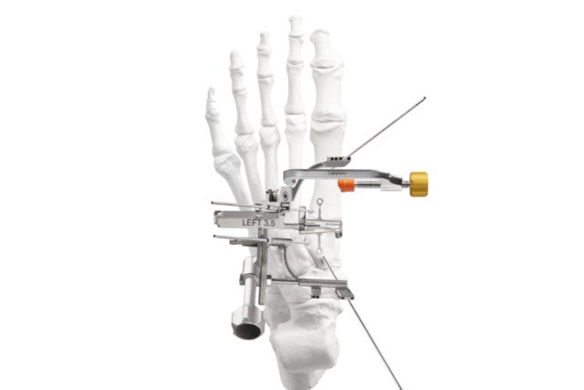 External fixation device on a skeletal foot model demonstrating orthopedic surgical equipment and procedure.