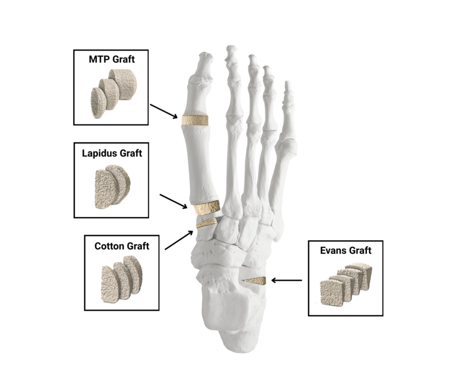 Illustration of a foot skeleton showing locations for MTP, Lapidus, Cotton, and Evans grafts.