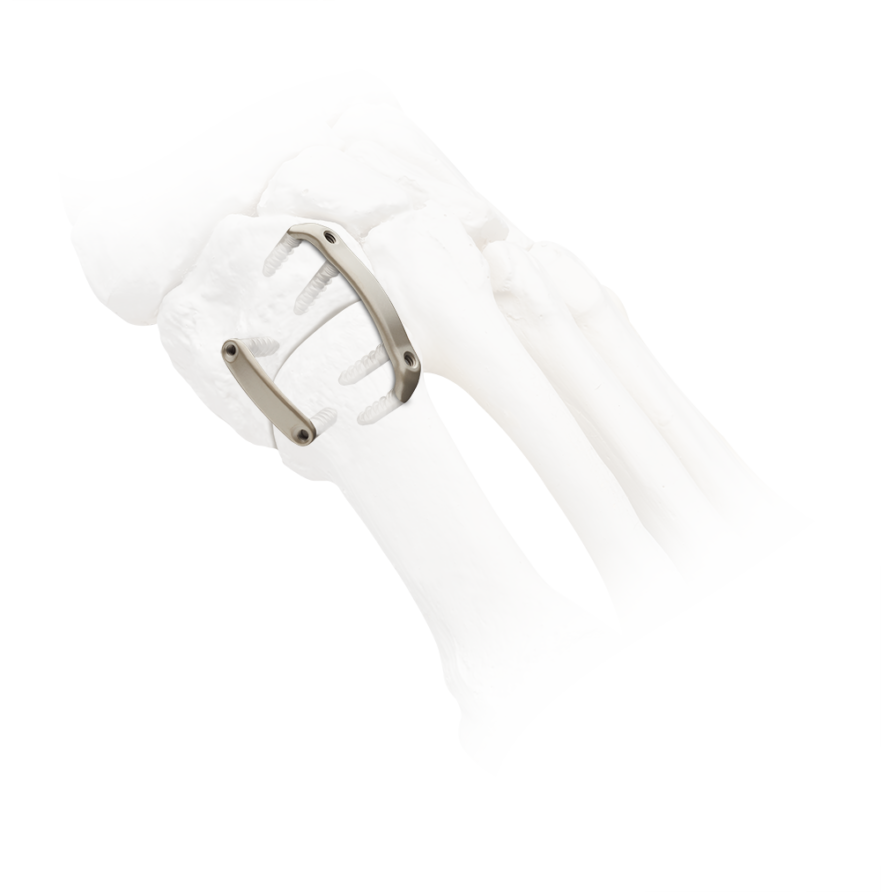 X-ray view of a foot skeleton with surgical metal implants on a white background.