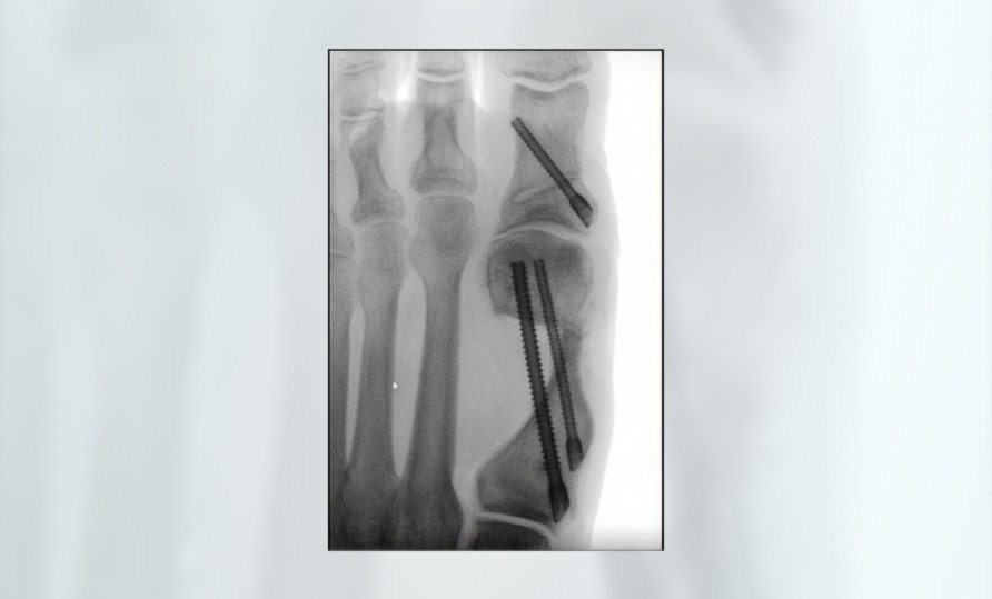 X-ray of a foot showing multiple surgical screws in bones.
