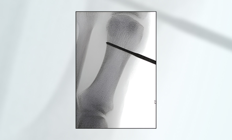 X-ray of a fractured bone with a metal pin inserted, focusing on healing and medical intervention.