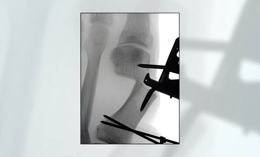 X-ray image of a knee joint with surgical tools visible in the foreground.