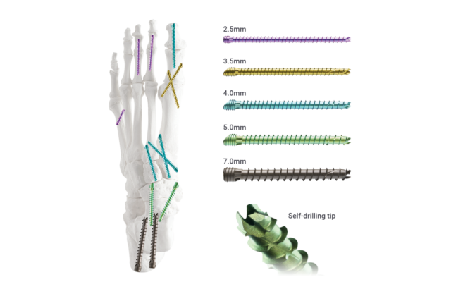 Surgical screws of various sizes with self-drilling tips shown next to a skeletal foot model demonstrating implantation.