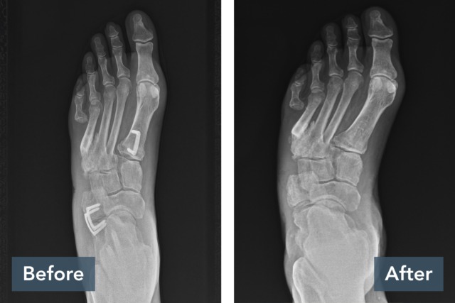 Before and after X-ray images showing a foot with corrections implemented in the "after" image.