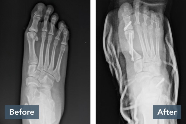 X-ray comparison of foot before and after surgery, showing metal pins and aligned bones in the right image.