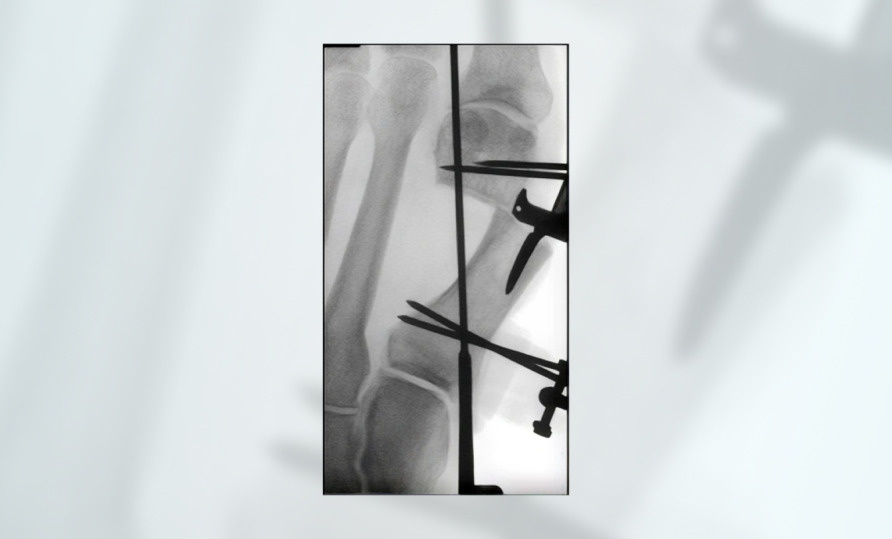 X-ray of broken leg with metal surgical fixator visible around the bone.