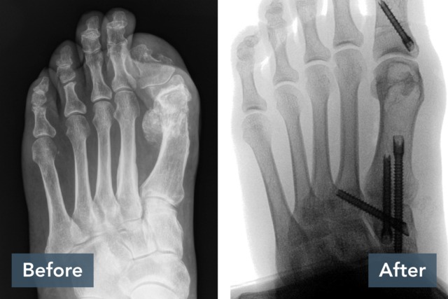 X-ray comparison of a foot before and after surgery, with screws visible in the post-surgery image on the right.